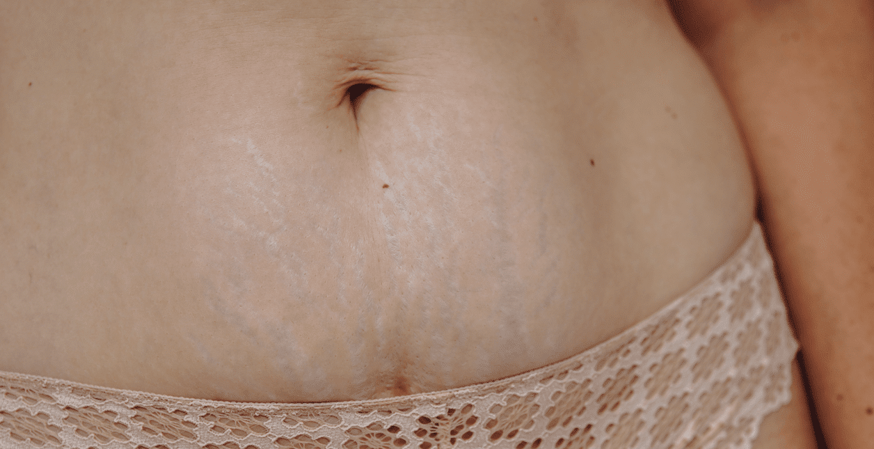 Postpartum lichaam na de bevalling (How About Mom)